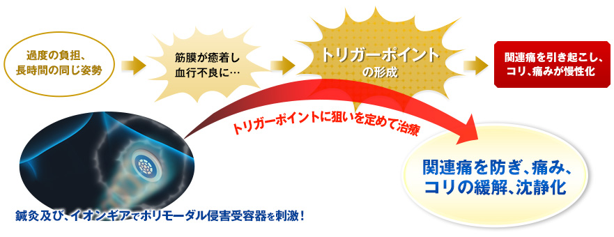 トリガーポイントに狙いを定めて治療、関連通を防ぎ、痛み、コリの寛解、鎮静化